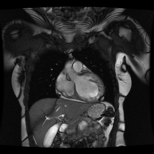 File:Non-compaction of the left ventricle (Radiopaedia 38868-41062 1CH SSFP CINE 3).jpg