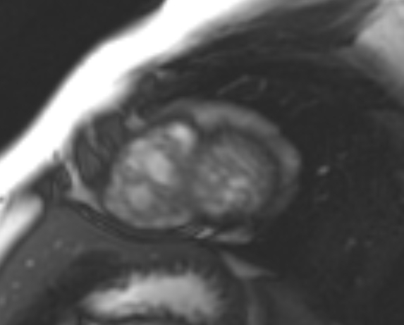 File:Non-compaction of the left ventricle (Radiopaedia 69436-79314 Short axis cine 41).jpg