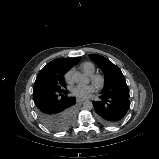 File:Non Hodgkin lymphoma in a patient with ankylosing spondylitis (Radiopaedia 84323-99624 Axial non-contrast 20).jpg
