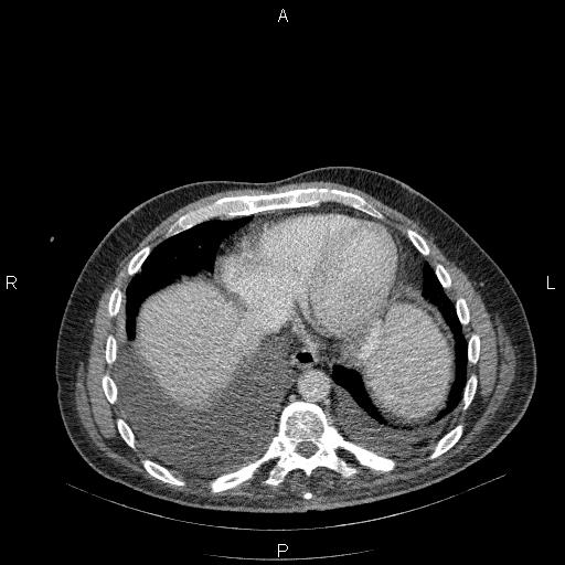 File:Non Hodgkin lymphoma in a patient with ankylosing spondylitis (Radiopaedia 84323-99624 B 22).jpg