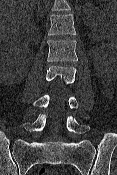 Normal CT lumbar spine (Radiopaedia 53981-60118 Coronal bone window 31).jpg