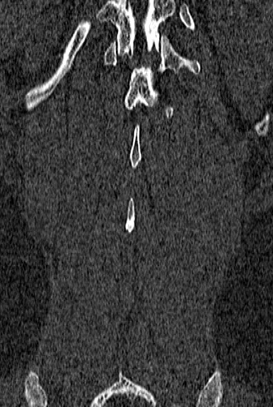 Normal CT lumbar spine (Radiopaedia 53981-60118 Coronal bone window 64).jpg
