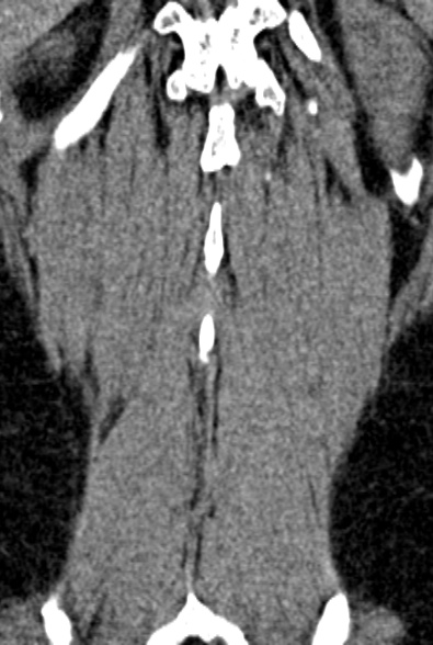 Normal CT lumbar spine (Radiopaedia 53981-60118 F 89).jpg