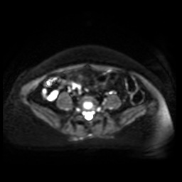 Normal MRI abdomen in pregnancy (Radiopaedia 88005-104548 Axial DWI 31).jpg