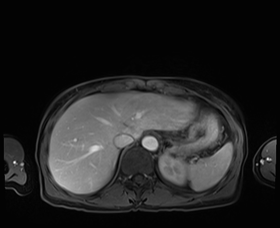 Normal adrenal glands MRI (Radiopaedia 82017-96004 K 18).jpg