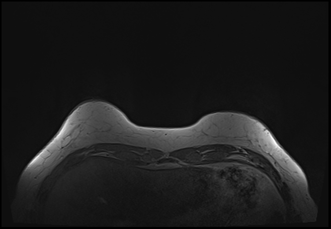 File:Normal breast MRI - dense breasts (Radiopaedia 80454-93850 Axial T1 22).jpg