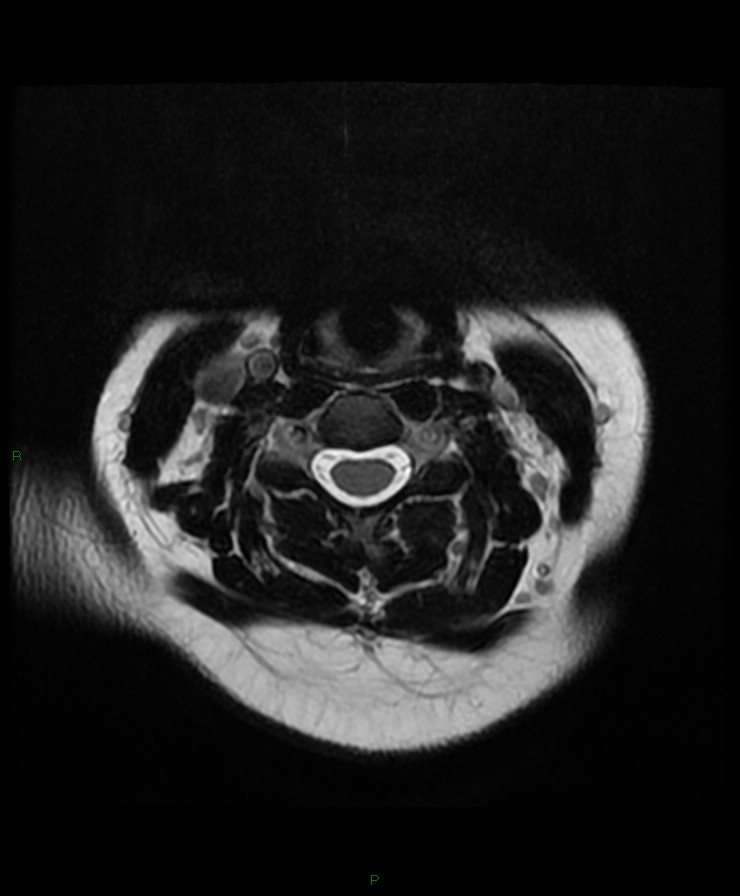Normal cervical spine MRI (Radiopaedia 80146-93454 Axial T2 39).jpg