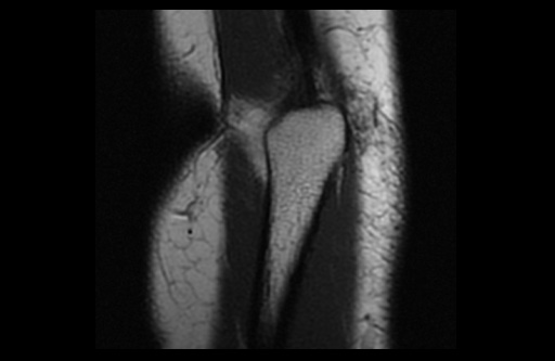 File:Normal elbow arthrograms (Radiopaedia 75550-86805 Coronal T1 3).jpg