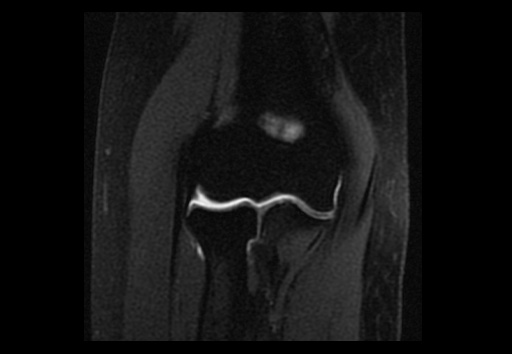 File:Normal elbow arthrograms (Radiopaedia 75550-86805 Coronal T1 fat sat 8).jpg