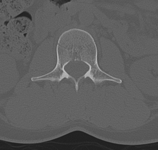File:Normal lumbar spine CT (Radiopaedia 46533-50986 Axial bone window 23).png