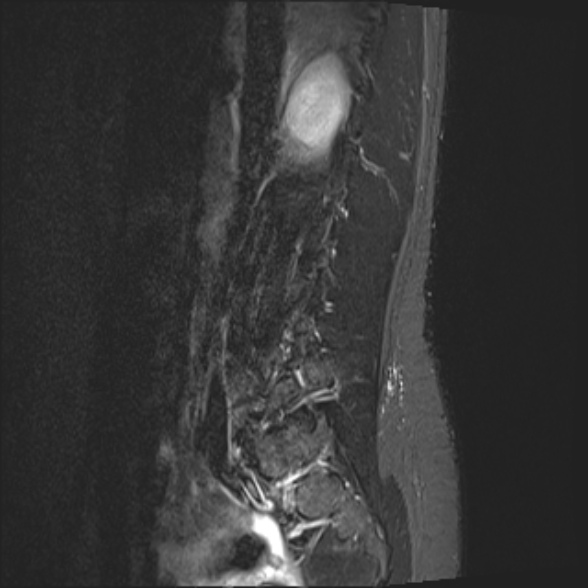 File:Normal lumbar spine MRI- 3 T (Radiopaedia 53280-59250 Sagittal STIR 5).jpg