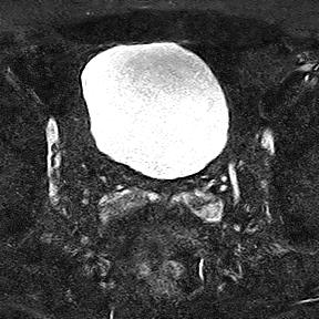 File:Normal prostate (MRI) (Radiopaedia 29986-30535 Axial STIR 23).jpg