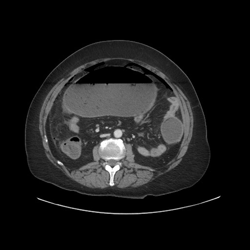 Obstructive distal colonic adenocarcinoma causing cecal perforation (Radiopaedia 86830-102989 A 100).jpg