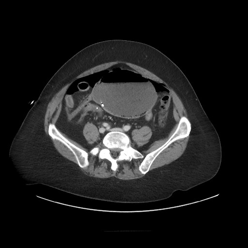 Obstructive distal colonic adenocarcinoma causing cecal perforation (Radiopaedia 86830-102989 A 137).jpg