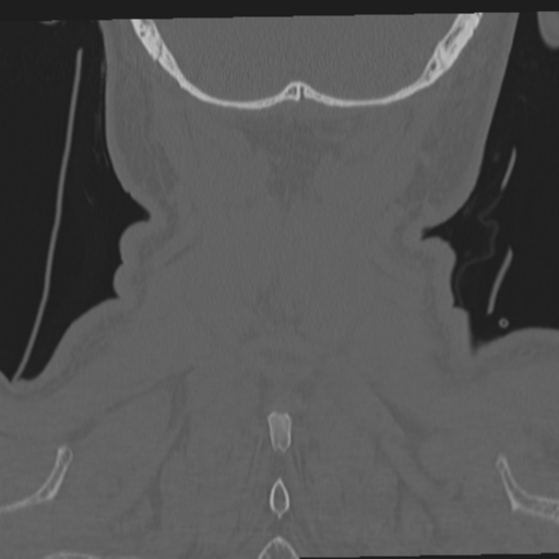 File:Occipital condyle fracture (Radiopaedia 33467-34517 Coronal bone window 64).png
