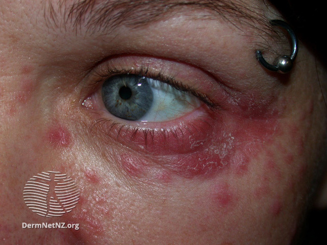 File:Perioral dermatitis (DermNet NZ acne-perioral-dermatitis-3434).jpg