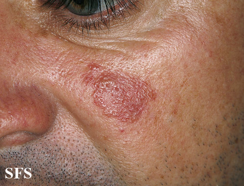 File:Sarcoidosis (Dermatology Atlas 18).jpg
