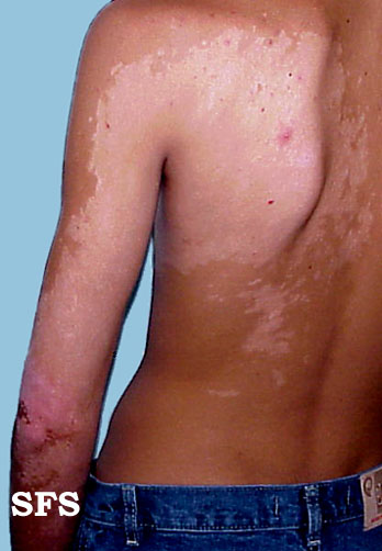 File:Vitiligo (Dermatology Atlas 14).jpg