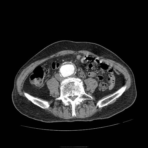 Abdominal aortic aneurysm (Radiopaedia 13341-13340 Axial C+ arterial phase 144).jpg