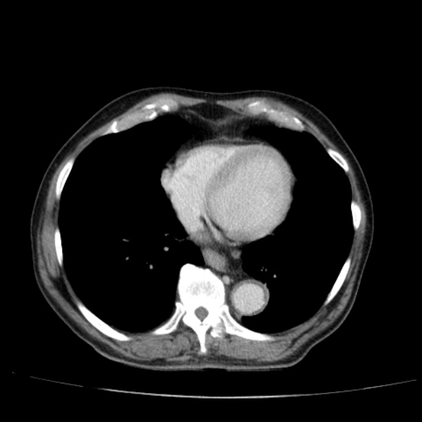 Abdominal aortic aneurysm (Radiopaedia 29248-29660 Axial C+ portal venous phase 3).jpg