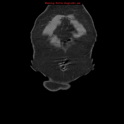 Abdominal aortic aneurysm (Radiopaedia 8190-9038 Coronal C+ arterial phase 4).jpg