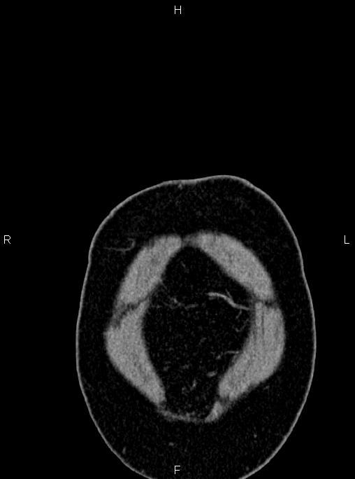 Abdominal aortic aneurysm (Radiopaedia 83094-97462 Coronal renal cortical phase 4).jpg
