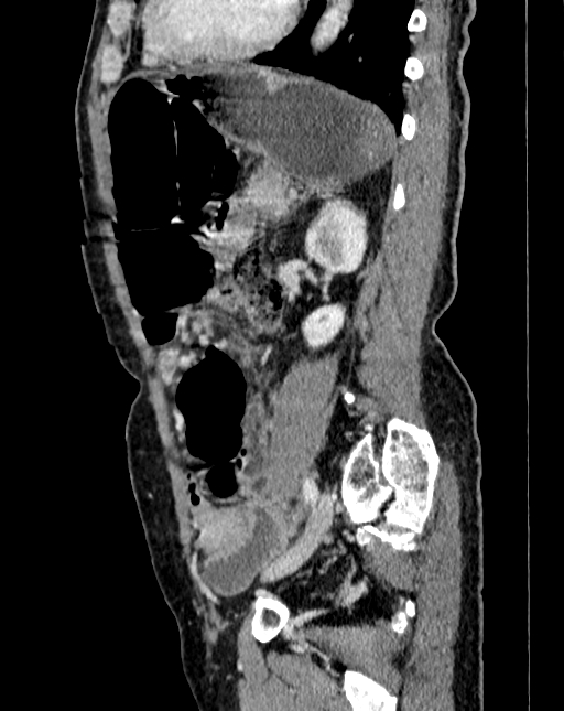 Abdominal aortic aneurysm (Radiopaedia 83581-98689 Sagittal C+ portal venous phase 85).jpg