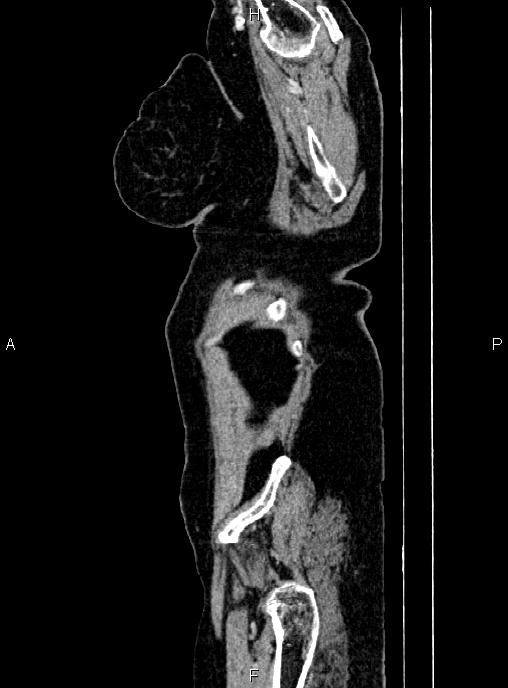 Abdominal aortic aneurysm (Radiopaedia 85063-100606 Sagittal C+ arterial phase 1).jpg