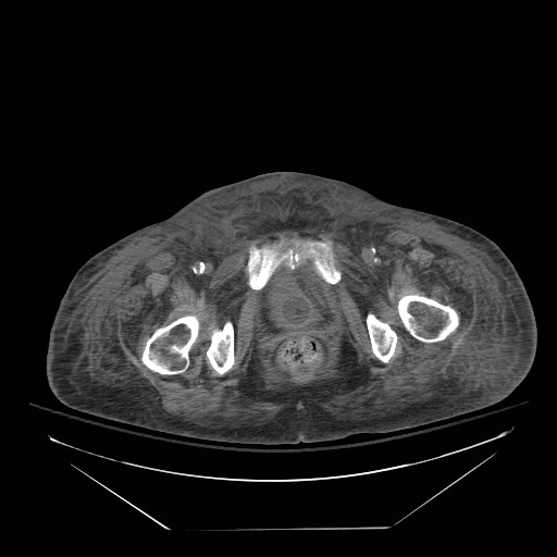 Abdominal aortic aneurysm - impending rupture (Radiopaedia 19233-19247 Axial non-contrast 165).jpg