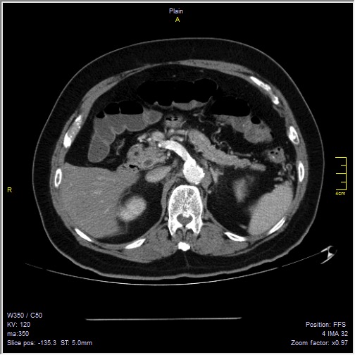 Abdominal aortic aneurysm with thrombus fissuration (Radiopaedia 47340-51926 Axial C+ arterial phase 16).jpg