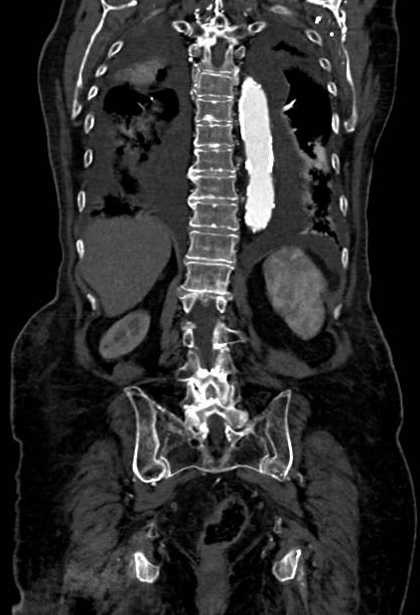 Abdominal aortic aneurysm with thrombus fissuration (Radiopaedia 73192-83919 Coronal C+ arterial phase 69).jpg