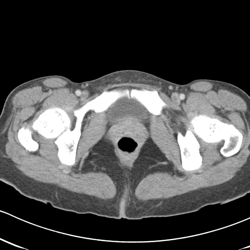 Abdominal desmoid tumor (Radiopaedia 41007-43740 Axial C+ portal venous phase 72).png