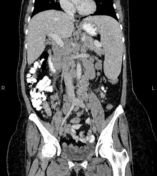 File:Abdominal lymphoma with sandwich sign (Radiopaedia 84378-99704 Coronal C+ portal venous phase 30).jpg