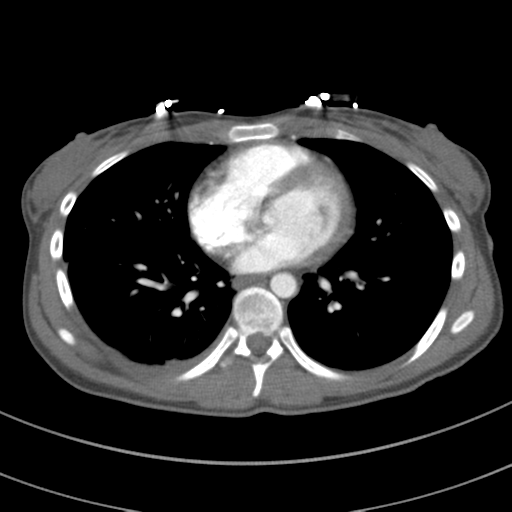 File:Abdominal multi-trauma - devascularised kidney and liver, spleen and pancreatic lacerations (Radiopaedia 34984-36486 Axial C+ arterial phase 53).png