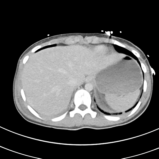 File:Abdominal multi-trauma - devascularised kidney and liver, spleen and pancreatic lacerations (Radiopaedia 34984-36486 Axial C+ delayed 9).png