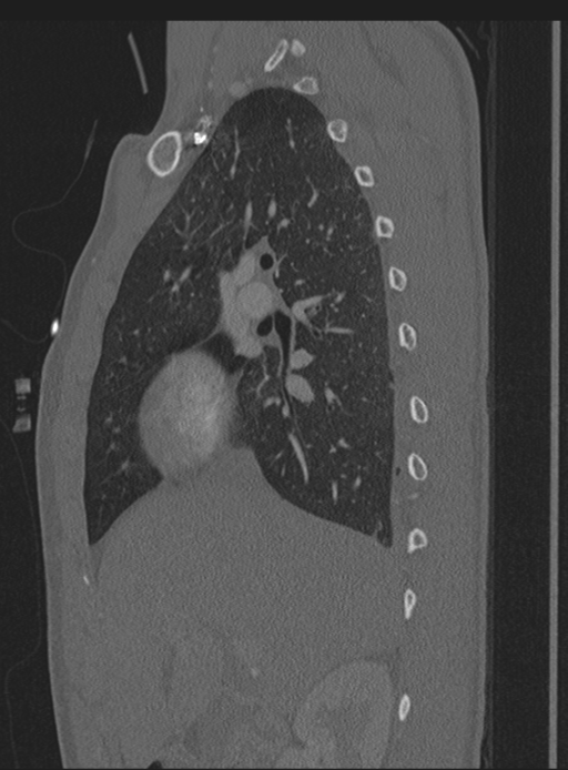 Abdominal multi-trauma - devascularised kidney and liver, spleen and pancreatic lacerations (Radiopaedia 34984-36486 Sagittal bone window 57).png