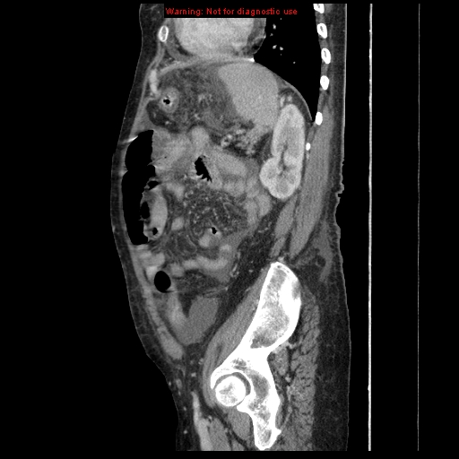 File:Abdominal wall hematoma (Radiopaedia 9427-10112 Sagittal C+ portal venous phase 30).jpg
