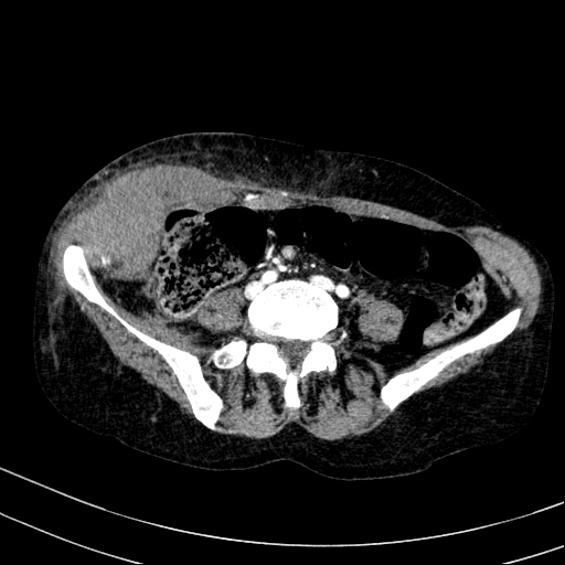 File:Abdominal wall hematoma with active bleeding (Radiopaedia 83915-99117 Axial renal cortical phase 80).jpg