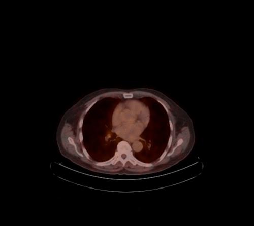 File:Abdominal wall metastasis from colorectal carcinoma (Radiopaedia 31016-31719 C 104).jpg