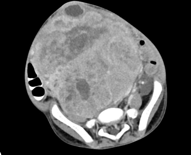 Abdominopelvic rhabdomyosarcoma (Radiopaedia 78356-90984 Axial C+ portal venous phase 120).jpg