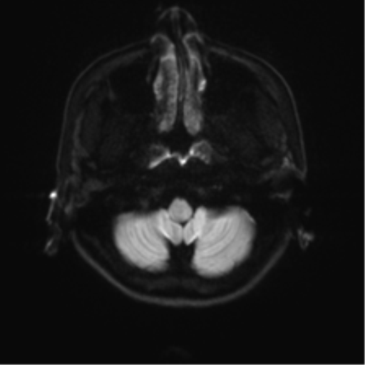 Abducens nerve palsy (Radiopaedia 51069-56648 Axial DWI 29).png