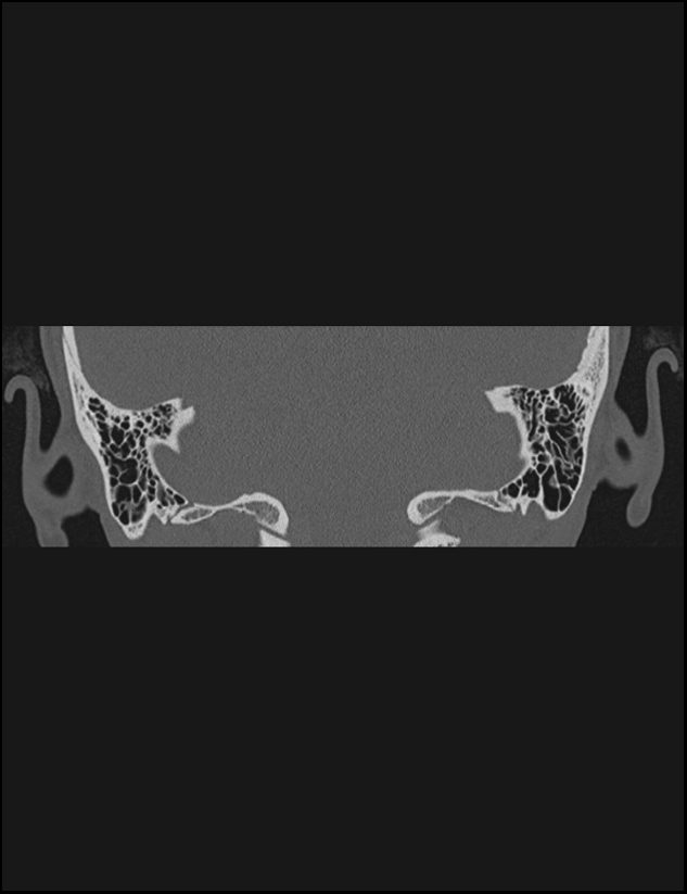 Aberrant right internal carotid artery (Radiopaedia 65191-74198 Coronal non-contrast 66).jpg