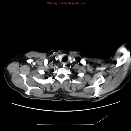 File:Aberrant right subclavian artery (Radiopaedia 9379-10071 Axial C+ arterial phase 5).jpg