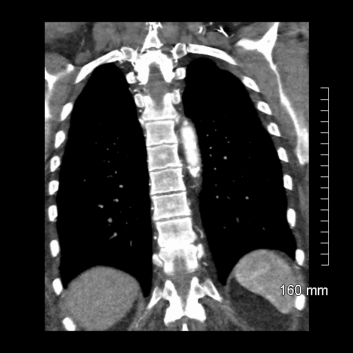 Aberrant right subclavian artery stenosis (Radiopaedia 52656-58670 B 66).jpg