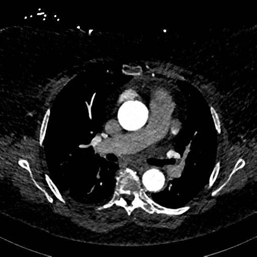 Aberrant right subclavian artery with Kommerell diverticulum (Radiopaedia 47982-52769 Axial C+ arterial phase 42).png