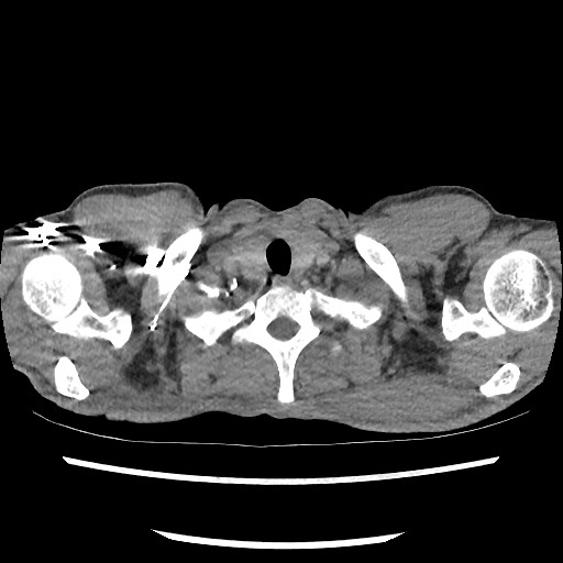 Accessory left horizontal fissure with lingular pneumonia (Radiopaedia 53763-59843 Axial C+ CTPA 6).jpg