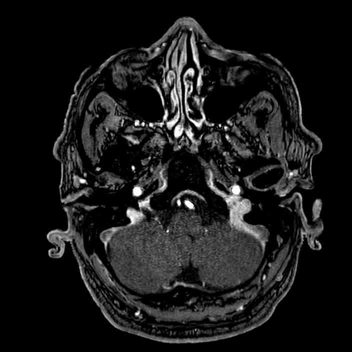 Accessory middle cerebral artery (Radiopaedia 73114-83828 Axial MRA 19).jpg