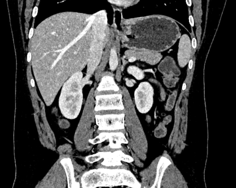 Accessory right inferior hepatic vein (Radiopaedia 75207-86305 Coronal C+ portal venous phase 38).jpg