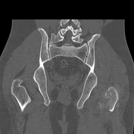 Acetabular and ilial fractures (Radiopaedia 59084-66378 Coronal bone window 37).jpg