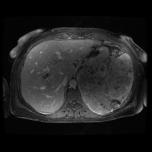 Acinar cell carcinoma of the pancreas (Radiopaedia 75442-86668 Axial T1 C+ fat sat 102).jpg